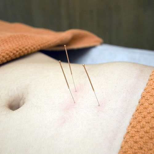 Acupuncture